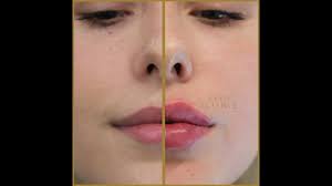 lip fillers skin science clinic london