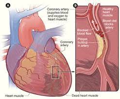 coronary artery disease cad cardiac