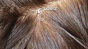 head lice screening lice clinics of