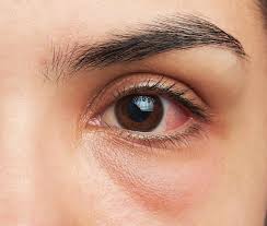 pink eye conjunctivitis types causes