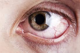 what s causing your itching teary eyes