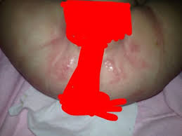 help bad diaper rash tmi pic