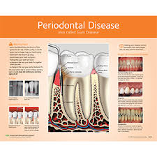 Periodontal Gum Disease Chart For Patient Education Ada W406