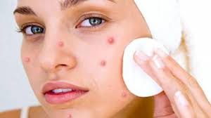 How to Reduce Swelling Acne Fast