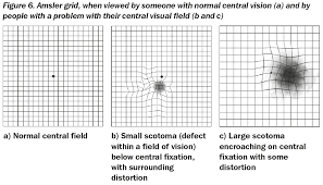 Community Eye Health Journal Visual Field Testing For