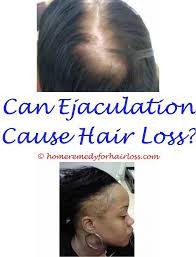 Poor nutrition is a form of stress which may cause these structures to enter the telogen resting phase. Hair Loss Control Hair Loss Clinic Vitamins For Hair Loss Hair Loss Men
