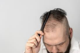 top 3 topical finasteride myths miami