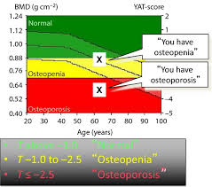 osteoporosis the evolution of a