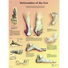 Anatomical Chart Deformities Of The Feet Paper