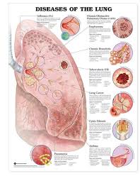 Diseases Of The Lung Anatomical Chart
