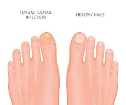 toenail discoloration making you