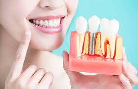 تعرف على مراحل زراعة الأسنان وفوائدها
