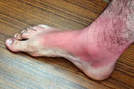 foot rash contact dermais alpine