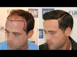 fue hair transplant 3958 grafts in nw