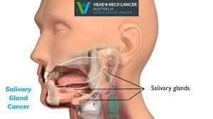 salivary gland cancer what is it