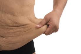 excess skin after significant weight loss