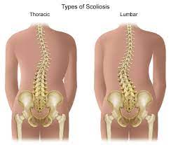 lumbar scoliosis explained scoliosis sos