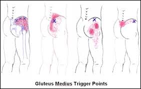 Lower Back Pain Trigger Points