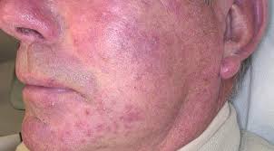 La rosacée est liée à une vasodilatation excessive des petits vaisseaux du visage et provoque d'abord des bouffées de chaleur au centre du visage, des rougeurs et des picotements. Dermato Info La Couperose Et La Rosacee