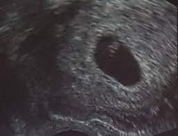 Ssw kann man im bauch der mutter den kleinen embryo in form einer bohne erkennen, der inzwischen etwa fünf millimeter vom scheitel bis zum steiß (ssl. Ultraschallbilder Mehr Als 50 Bilder Aus Der Schwangerschaft Faminino