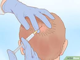 If being flat chested runs in the population. 7 Ways To Fix A Receding Hairline Wikihow