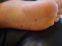 black spots on bottom of foot pic