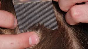 home remes for treating head lice
