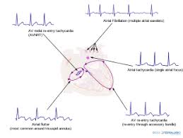 It occurs when a short circuit rhythm develops in the upper chamber of the heart. Supraventricular Tachycardia Wikipedia