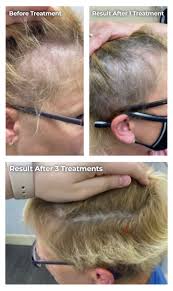hair loss treatment cincinnati