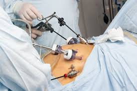 bariatric surgery preparation