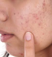 diagnosis and treatment of acne scars