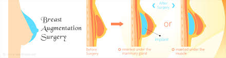 Breast Augmentation Surgery Types Indications Surgical