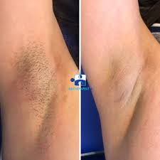 laser hair removal free consultation