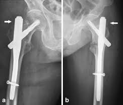 results of the proximal fem nail