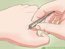 How to get cactus spines out of skin. How To Remove Cactus Spines From Skin With Tweezer Glue How To Remove Cactus Skin