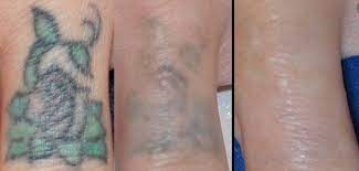 types of laser tattoo removal how