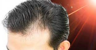 Some experts suggest that lllt may be an effective treatment for hair loss. Low Level Laser Therapy To Combat Hair Loss