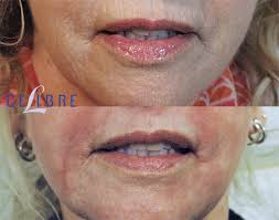 botox for smokers lines before and