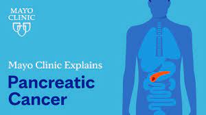 pancreatic cancer symptoms and causes