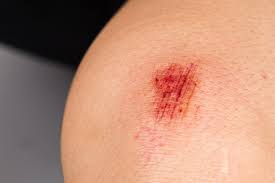 abrasions types causes treatments