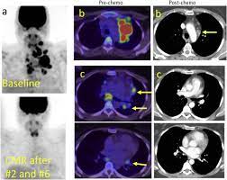 involved site radiation therapy in