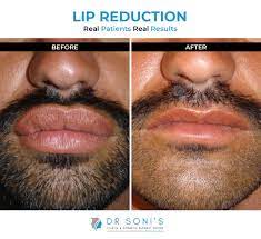 lip reduction surgery lip thinning