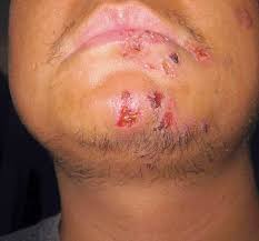 shingles herpes zoster a one sided