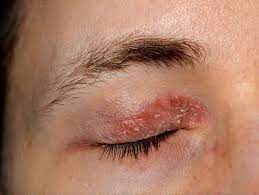 dry skin around eyes causes treatment