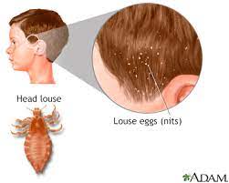Maybe you would like to learn more about one of these? Head Lice Information Mount Sinai New York