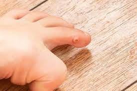 treatment options for plantar warts