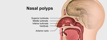 Nasal Polyps: Causes, Symptoms And Treatment | Netmeds