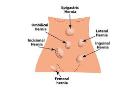 They become a disease when swollen or inflamed; Femoral Hernia Los Angeles Hemorrhoid Clinic