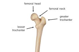 proximal fem fracture