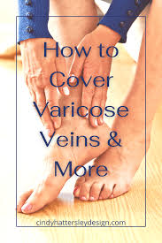 how to cover varicose veinore
